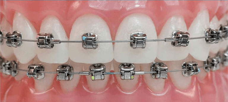 Imagem do uso de aparelho